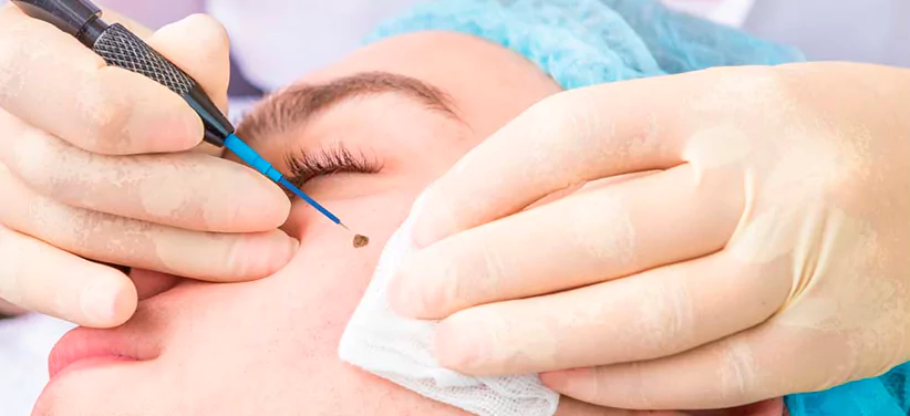 Electrocautery